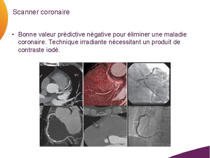 Scanner coronaire • Bonne valeur prédictive négative pour éliminer une maladie coronaire. Technique irradiante