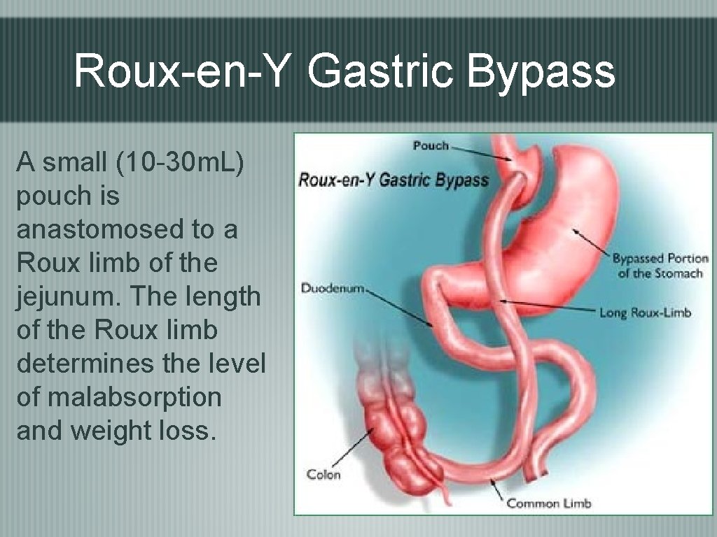 Roux-en-Y Gastric Bypass A small (10 -30 m. L) pouch is anastomosed to a