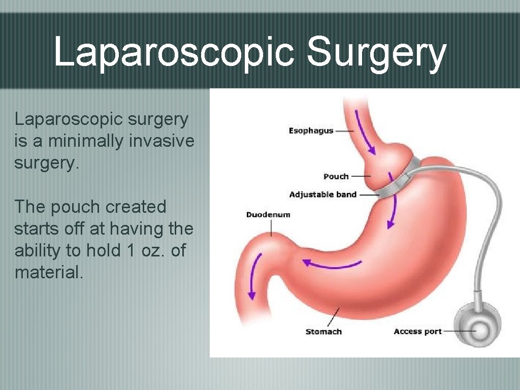 Laparoscopic Surgery Laparoscopic surgery is a minimally invasive surgery. The pouch created starts off