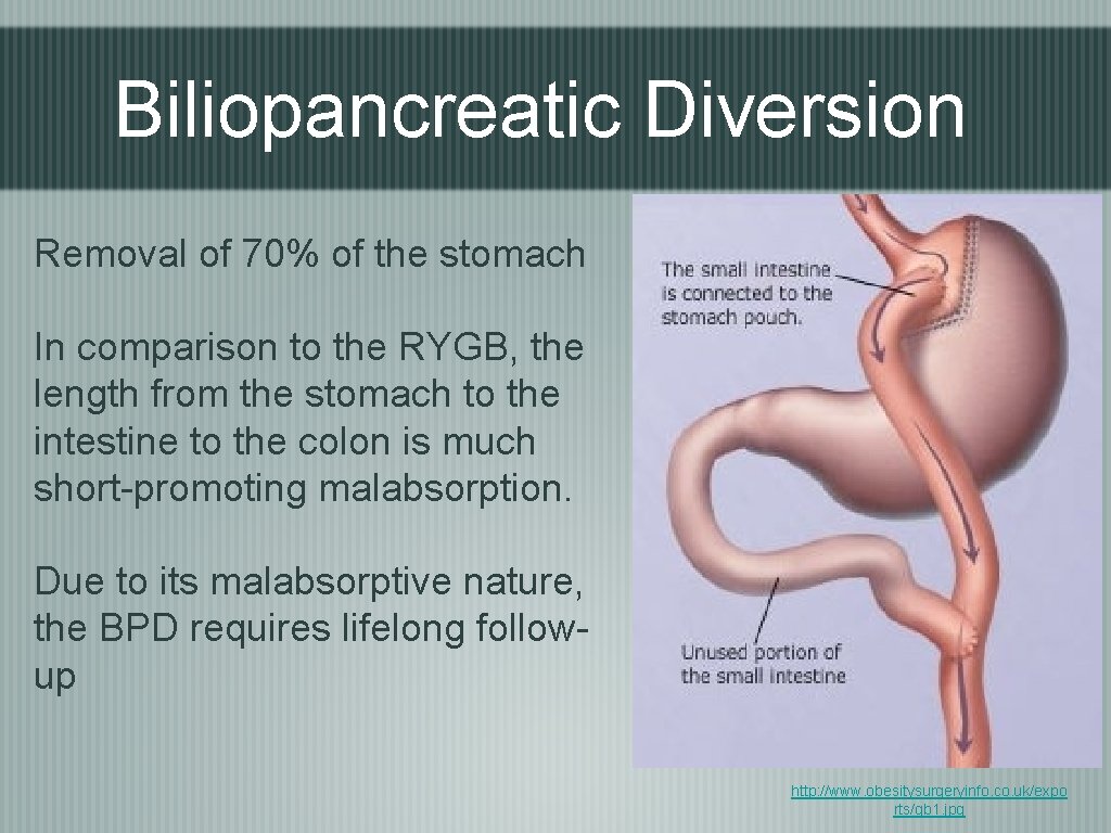 Biliopancreatic Diversion Removal of 70% of the stomach In comparison to the RYGB, the