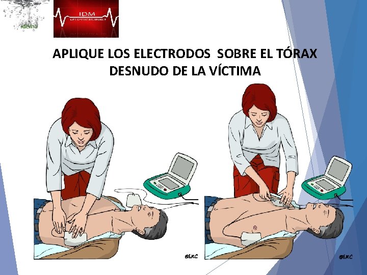 APLIQUE LOS ELECTRODOS SOBRE EL TÓRAX DESNUDO DE LA VÍCTIMA 