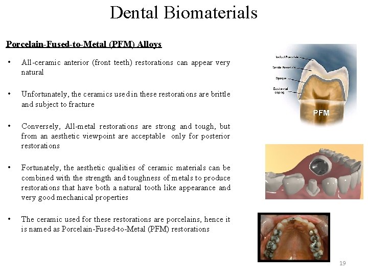 Dental Biomaterials Porcelain-Fused-to-Metal (PFM) Alloys • All-ceramic anterior (front teeth) restorations can appear very