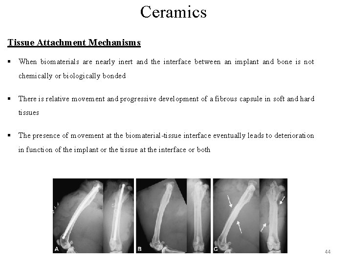 Ceramics Tissue Attachment Mechanisms § When biomaterials are nearly inert and the interface between