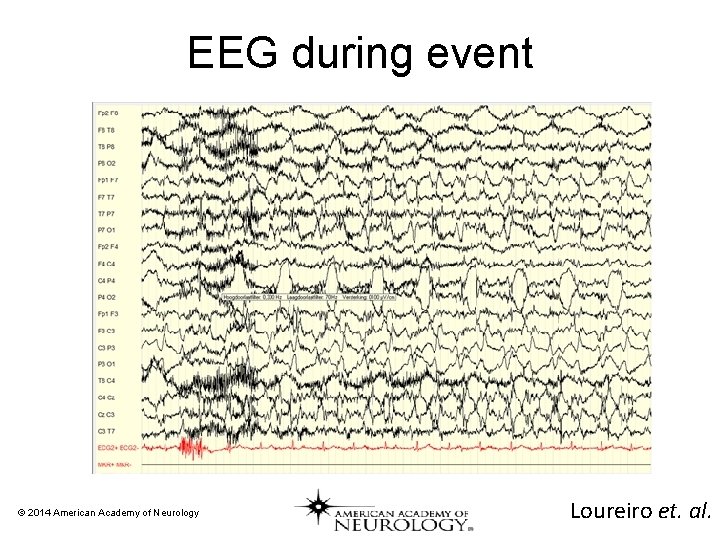 EEG during event © 2014 American Academy of Neurology Loureiro et. al. 