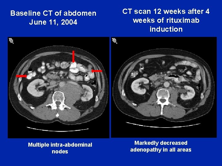 Baseline CT of abdomen June 11, 2004 Multiple intra-abdominal nodes CT scan 12 weeks