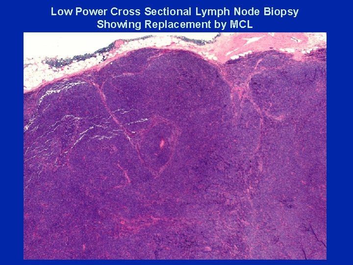 Low Power Cross Sectional Lymph Node Biopsy Showing Replacement by MCL 