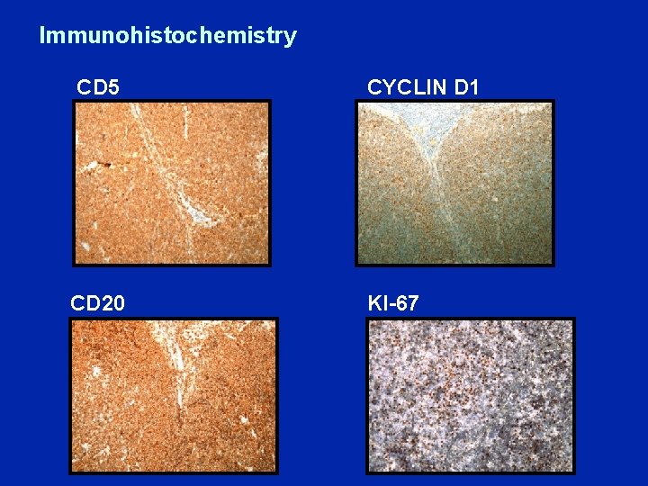 Immunohistochemistry CD 5 CD 20 CYCLIN D 1 KI-67 