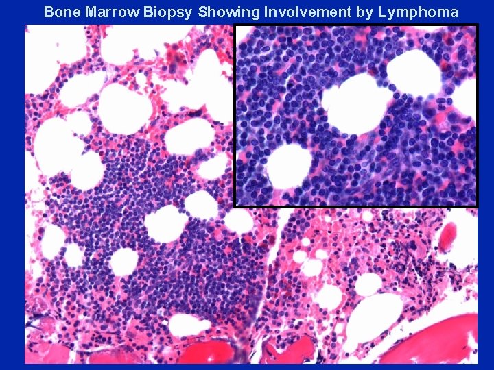 Bone Marrow Biopsy Showing Involvement by Lymphoma 