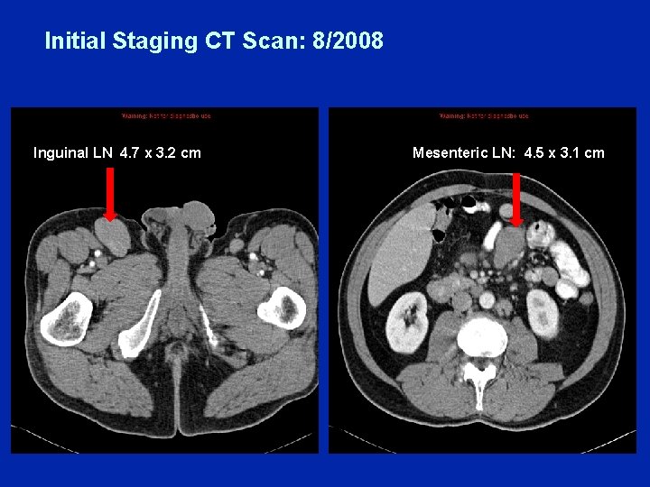 Initial Staging CT Scan: 8/2008 Inguinal LN 4. 7 x 3. 2 cm Mesenteric