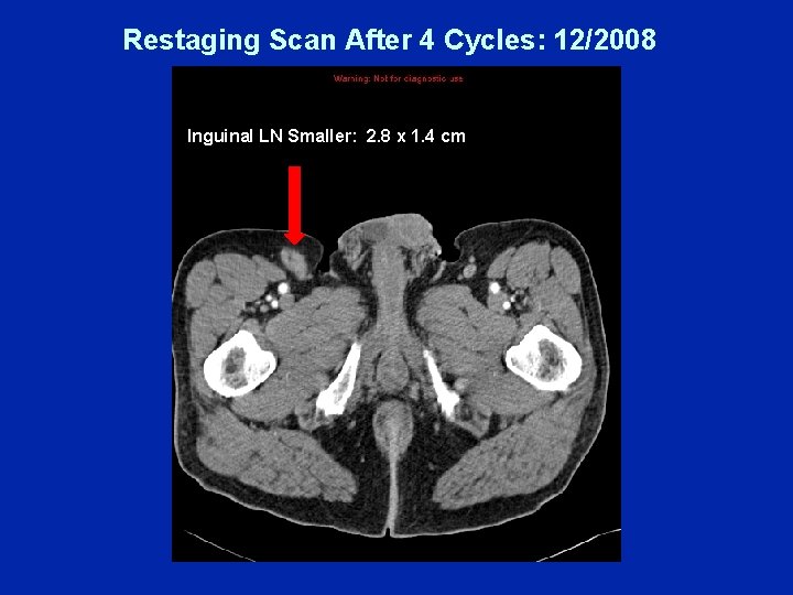 Restaging Scan After 4 Cycles: 12/2008 Inguinal LN Smaller: 2. 8 x 1. 4