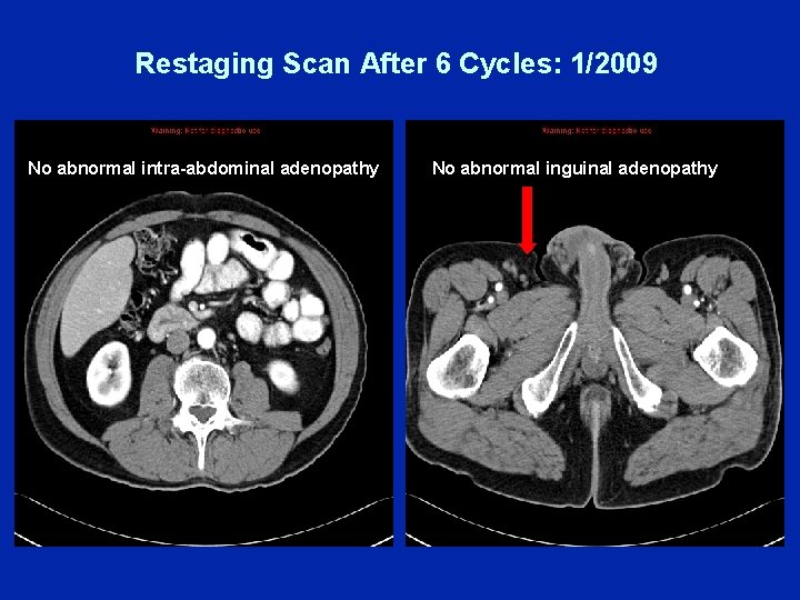 Restaging Scan After 6 Cycles: 1/2009 No No abnormal intra-abdominal adenopathy No abnormal inguinal