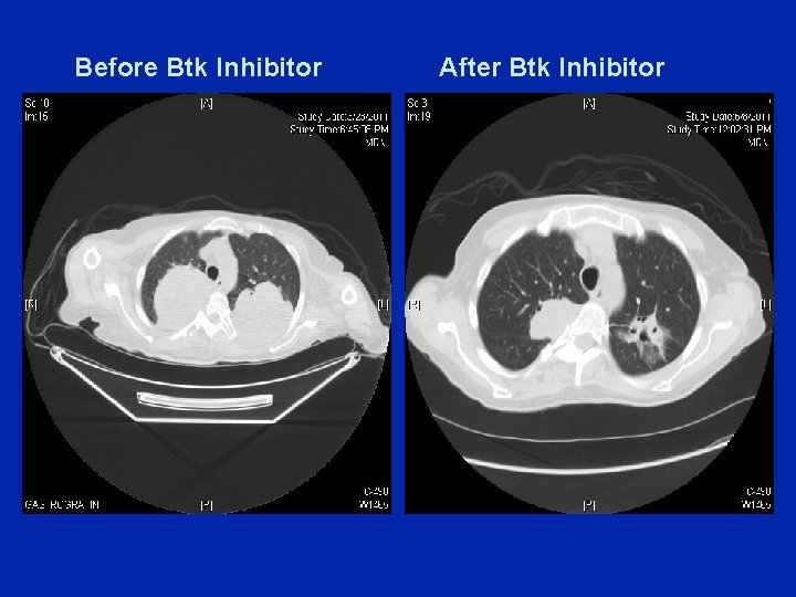 Before Btk Inhibitor After Btk Inhibitor 