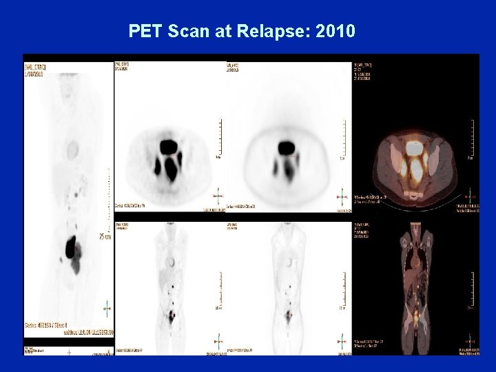 PET Scan at Relapse: 2010 