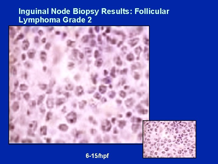 Inguinal Node Biopsy Results: Follicular Lymphoma Grade 2 6 -15/hpf 