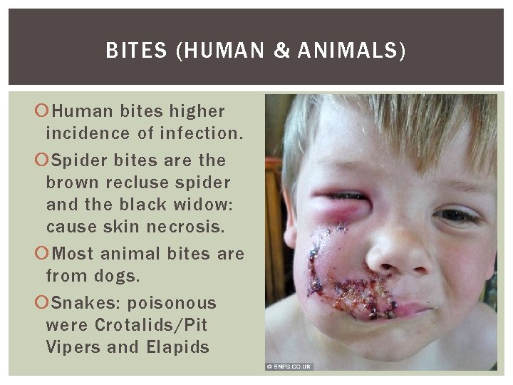 BITES (HUMAN & ANIMALS) Human bites higher incidence of infection. Spider bites are the