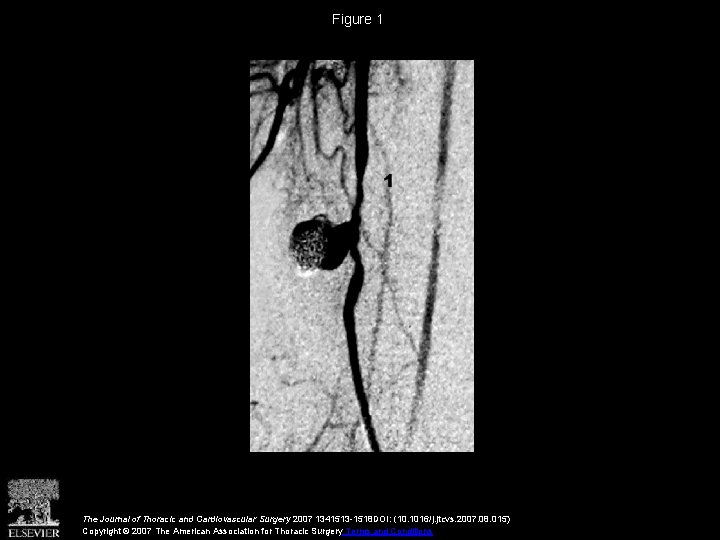 Figure 1 The Journal of Thoracic and Cardiovascular Surgery 2007 1341513 -1518 DOI: (10.