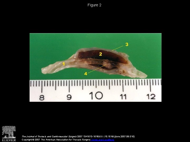 Figure 2 The Journal of Thoracic and Cardiovascular Surgery 2007 1341513 -1518 DOI: (10.