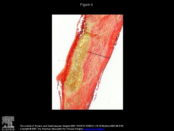 Figure 4 The Journal of Thoracic and Cardiovascular Surgery 2007 1341513 -1518 DOI: (10.