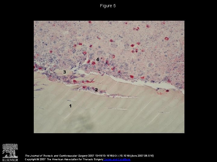 Figure 5 The Journal of Thoracic and Cardiovascular Surgery 2007 1341513 -1518 DOI: (10.