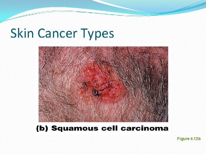 Skin Cancer Types Figure 4. 12 b Skin Cancer Types Figure 4. 12 b