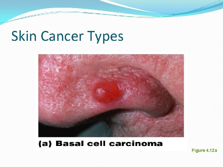 Skin Cancer Types Figure 4. 12 a Skin Cancer Types Figure 4. 12 a