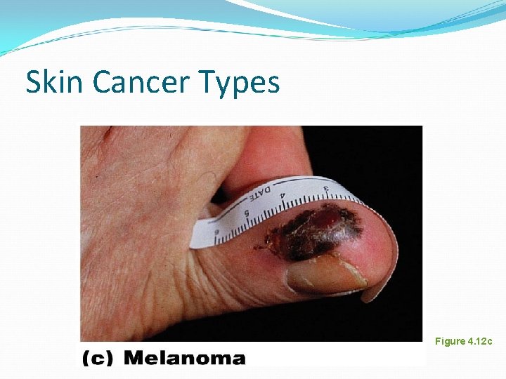 Skin Cancer Types Figure 4. 12 c Skin Cancer Types Figure 4. 12 c
