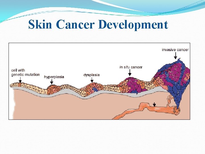 Skin Cancer Development Skin Cancer Development