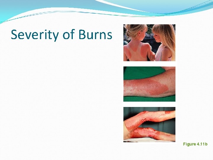Severity of Burns Figure 4. 11 b Severity of Burns Figure 4. 11 b