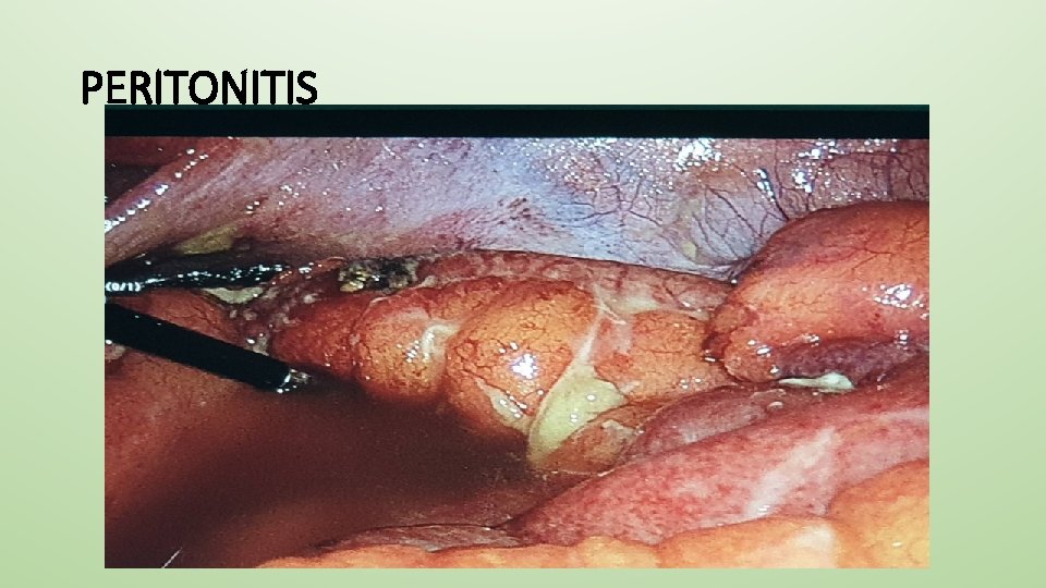 PERITONITIS 