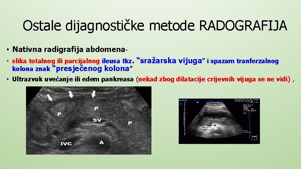 Ostale dijagnostičke metode RADOGRAFIJA • Nativna radigrafija abdomena • slika totalnog ili parcijalnog ileusa