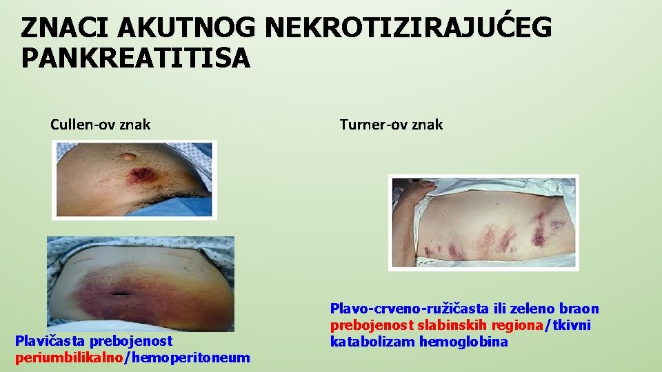 ZNACI AKUTNOG NEKROTIZIRAJUĆEG PANKREATITISA Cullen-ov znak Plavičasta prebojenost periumbilikalno/hemoperitoneum Turner-ov znak Plavo-crveno-ružičasta ili zeleno