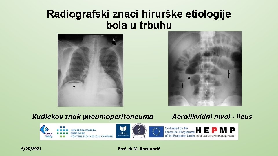 Radiografski znaci hirurške etiologije bola u trbuhu Kudlekov znak pneumoperitoneuma 9/20/2021 Prof. dr M.