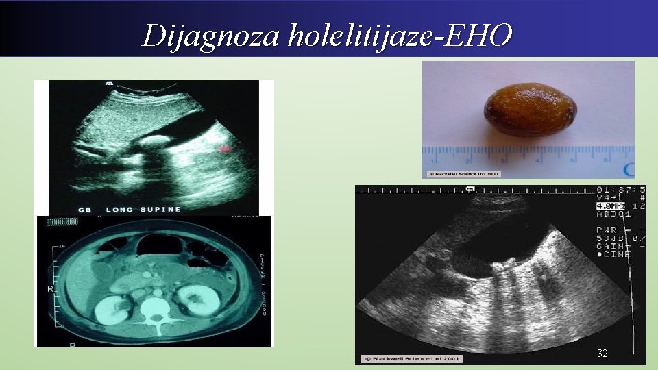 Dijagnoza holelitijaze-EHO 32 