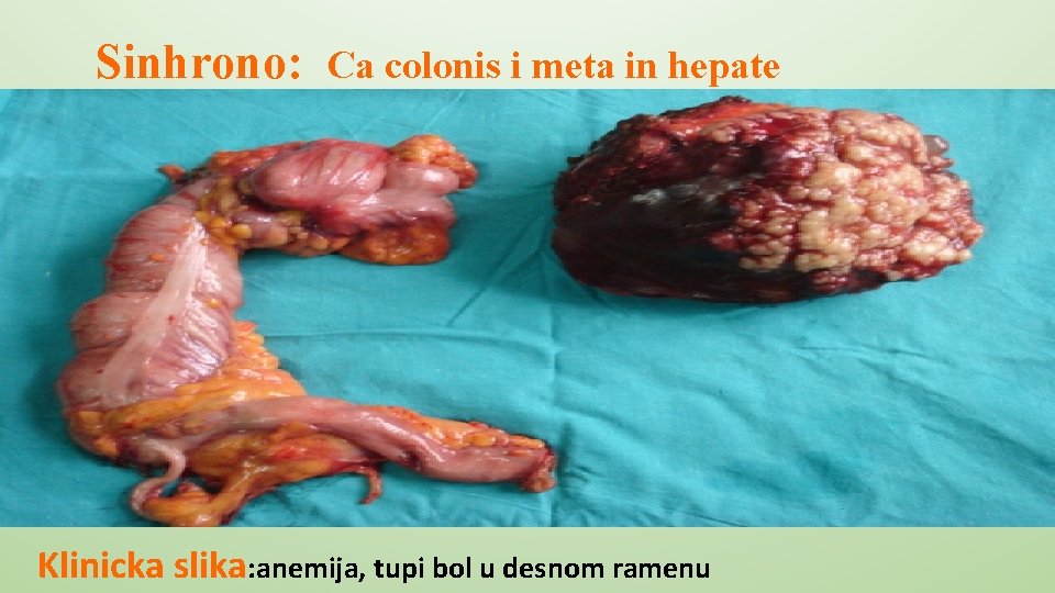 Sinhrono: Ca colonis i meta in hepate Klinicka slika: anemija, tupi bol u desnom