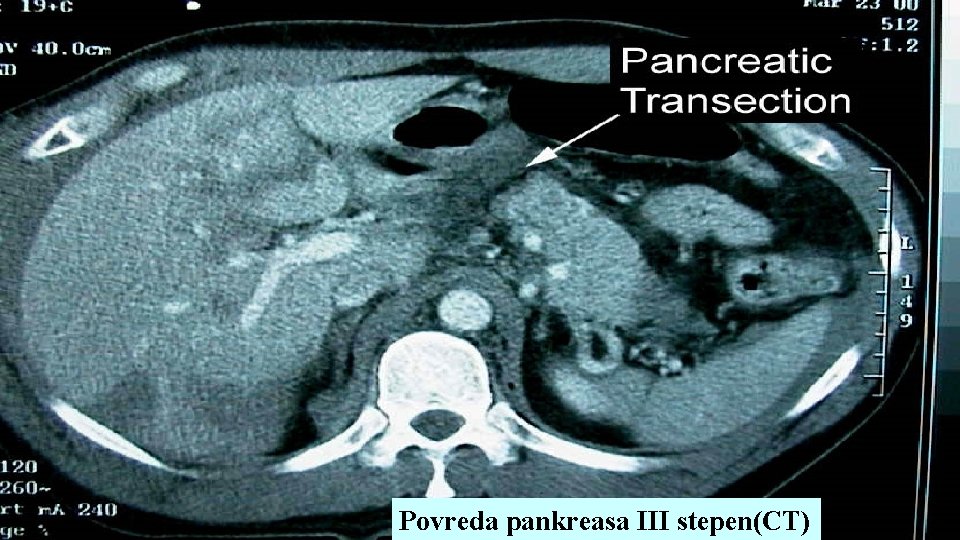 Povreda pankreasa III stepen(CT) 