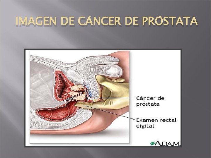 IMAGEN DE CÁNCER DE PRÓSTATA 