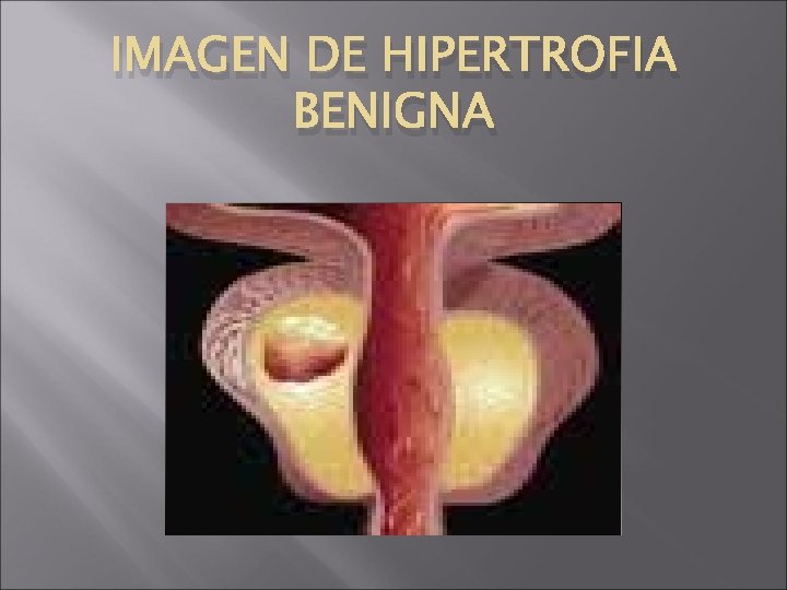 IMAGEN DE HIPERTROFIA BENIGNA 