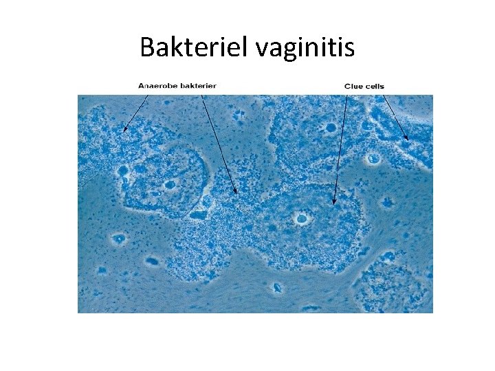 Bakteriel vaginitis 