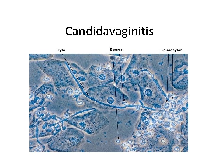 Candidavaginitis 