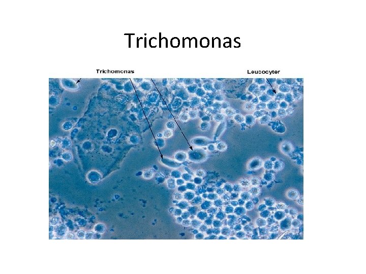 Trichomonas 