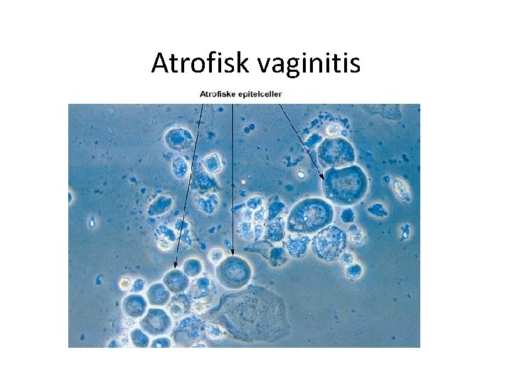 Atrofisk vaginitis 