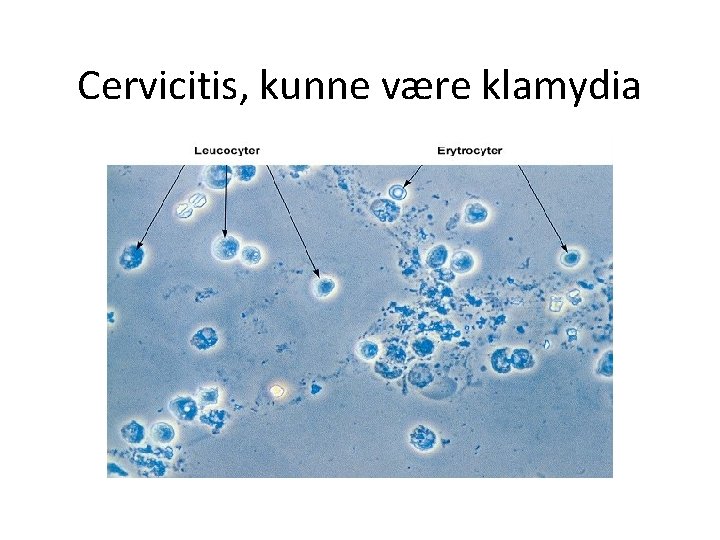Cervicitis, kunne være klamydia 