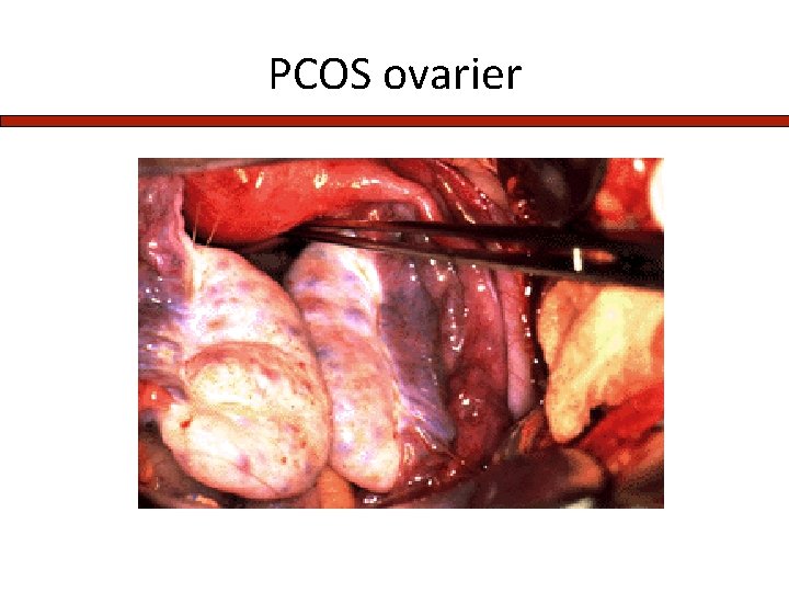 PCOS ovarier 
