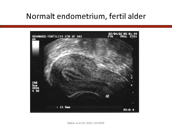 Normalt endometrium, fertil alder Møller et al UFL 2002, 164: 4539 