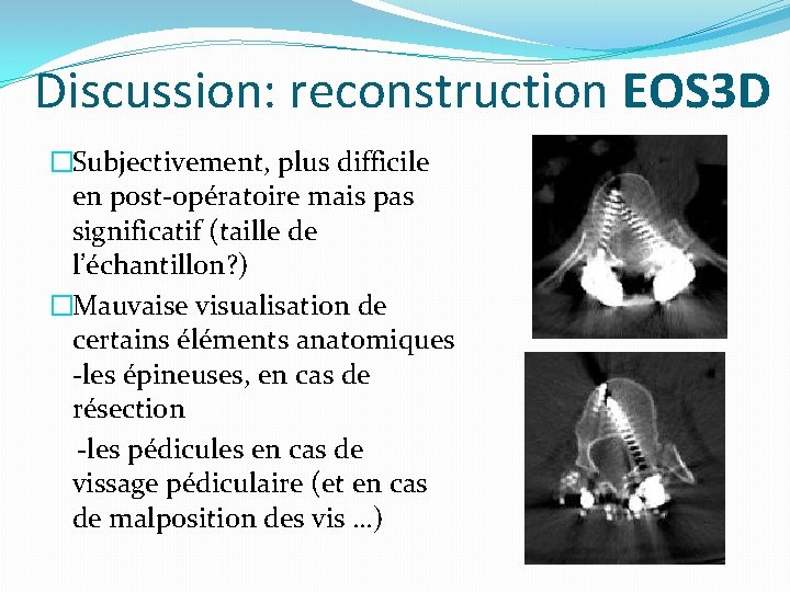 Discussion: reconstruction EOS 3 D �Subjectivement, plus difficile en post-opératoire mais pas significatif (taille