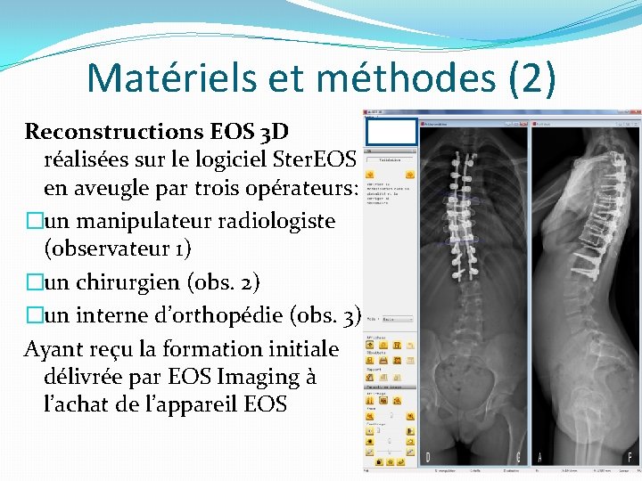 Matériels et méthodes (2) Reconstructions EOS 3 D réalisées sur le logiciel Ster. EOS