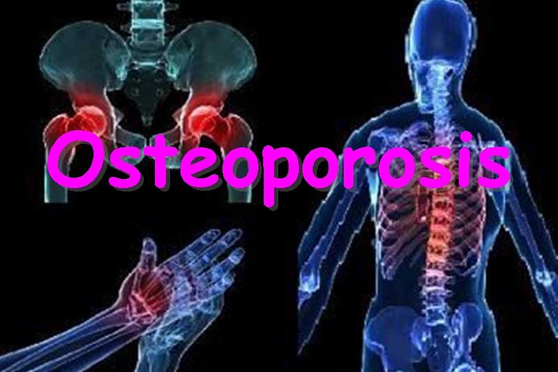Osteoporosis 