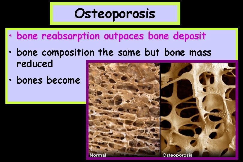 Osteoporosis • bone reabsorption outpaces bone deposit • bone composition the same but bone