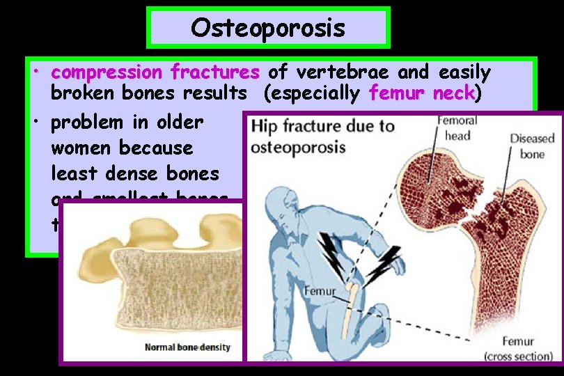 Osteoporosis • compression fractures of vertebrae and easily broken bones results (especially femur neck)