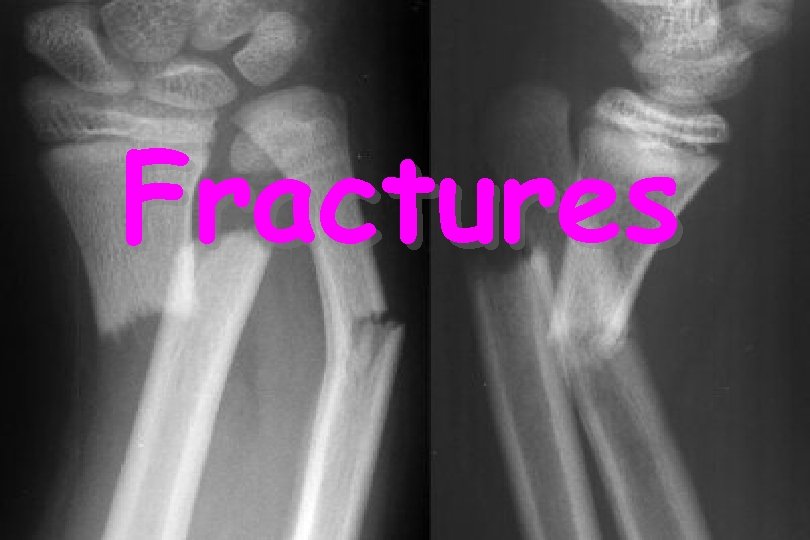 Fractures 